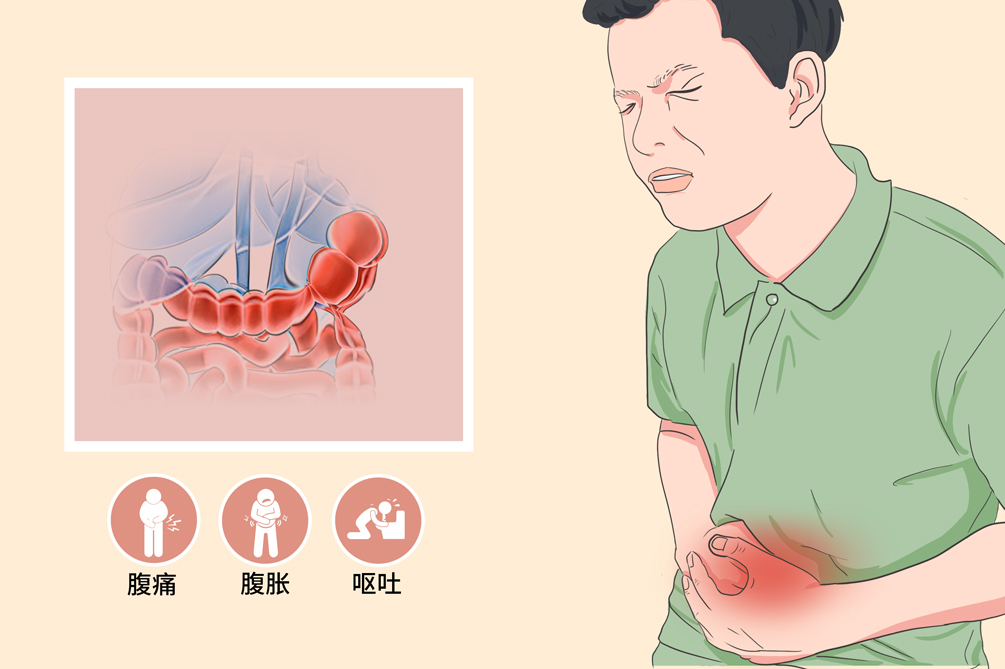 贊！不用開刀，一根導(dǎo)管打通腸梗阻！