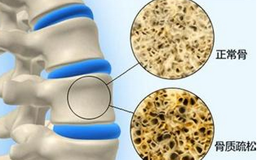 骨質(zhì)疏松，不僅補(bǔ)鈣這么簡單！